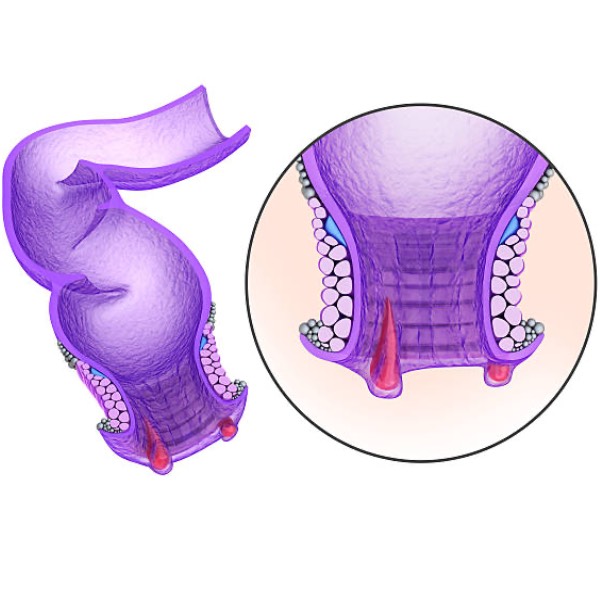 Fistulas y enfermedad hemorroidal