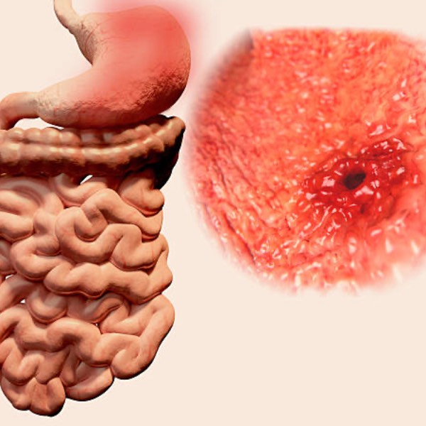 Perforaciones gastrointestinales